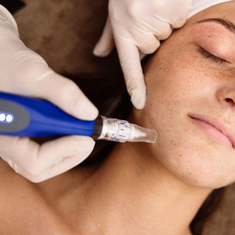SkinPen microneedling bij Clé de Beauté in Brugge