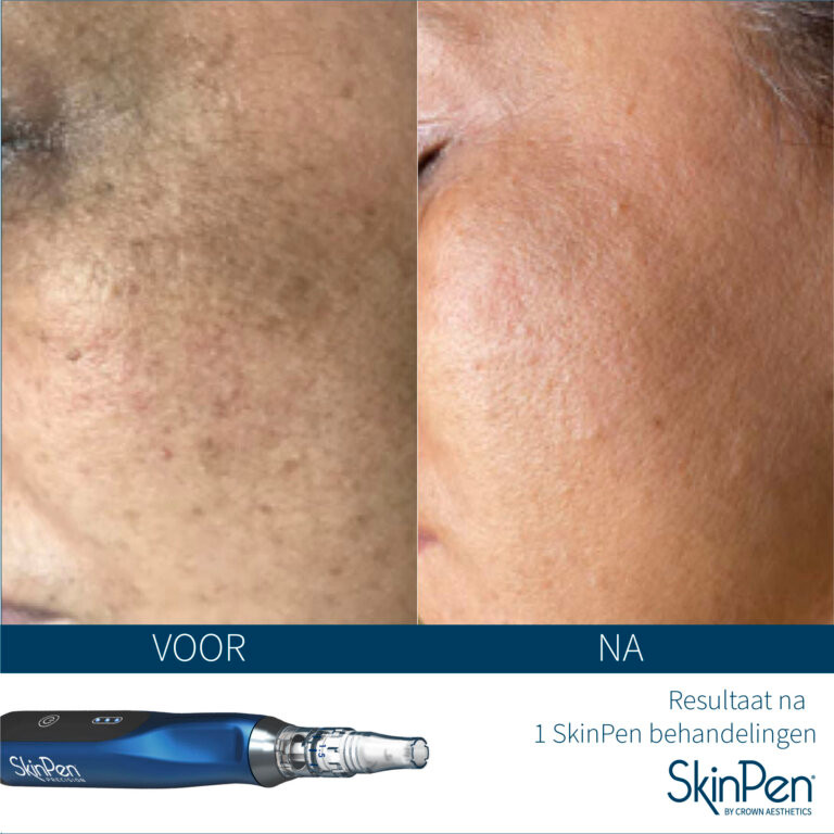 SkinPen voor en na één behandeling