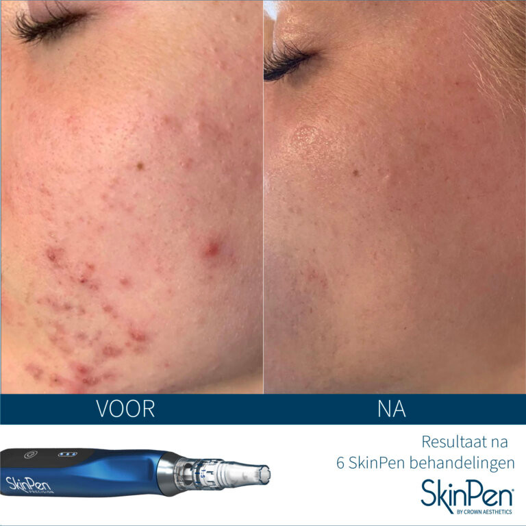 SkinPen voor en na zes behandelingen